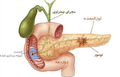 چطور بفهمیم لوزالمعده مان بیمار است؟