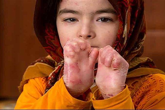 بیماری ای بی باید به عنوان بیماری خاص ثبت شود