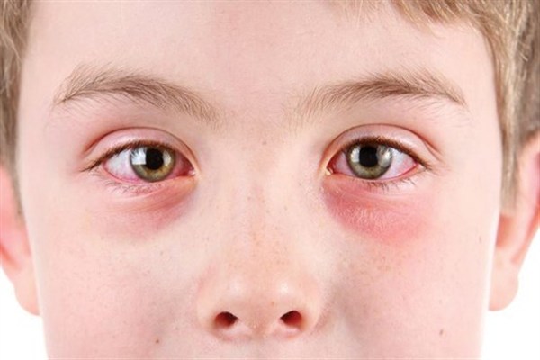 قرمزی چشم در کودکان،آیا مشکلی ایجاد می کند؟