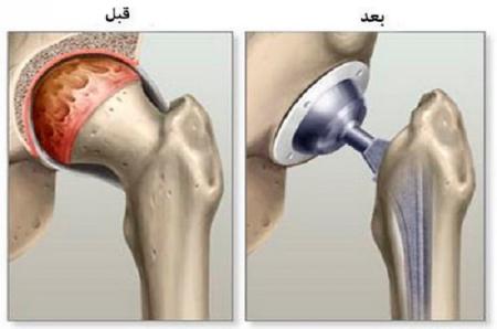 عوارض تعویض مفصل هیپ