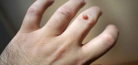 زگیل از این راه ها به صورت صد درصد منتقل می شود