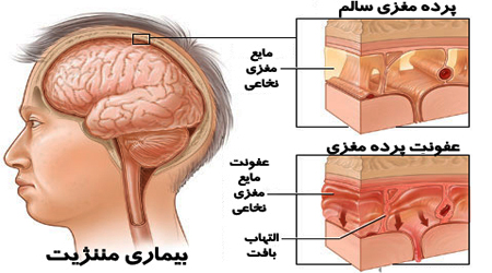 نشانه های مننژیت را جدی بگیرید