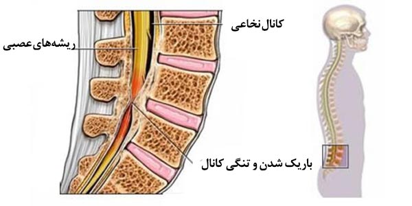  تنگی کانال نخاع در اثر سرخوردگی مهره‌ها