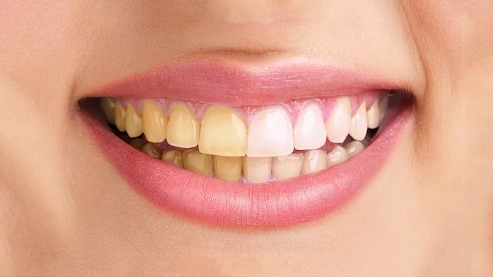 زردی دندان ها نشانه چیست؟ 