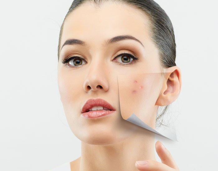 ۱۰ گام برای بهبود آکنه