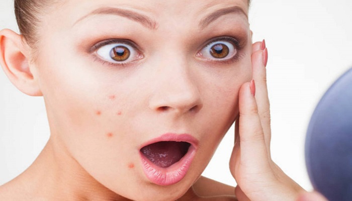 جوش های ناخوانده صورتمان را چگونه درمان کنیم ؟ 