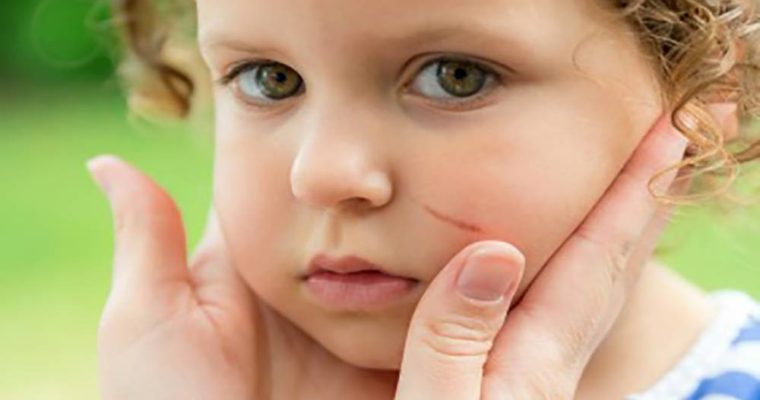 زخمهای بدن خردسالان را چگونه باید ترمیم کنیم