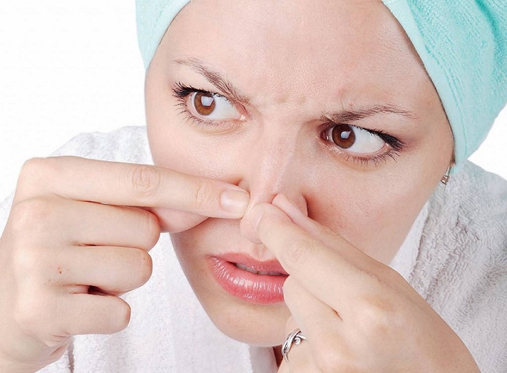 رفع جوش‌های سرسیاه با روش های طبیعی