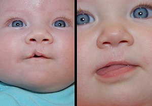  بررسی درمان اختلالات مادرزادی در کنگره جراحان دهان، فک و صورت ایران