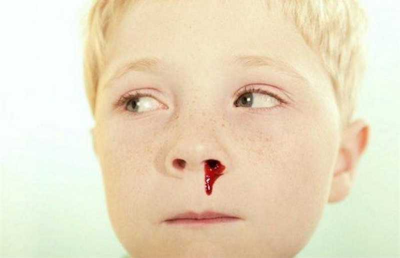 چرا خون دماغ می شویم؟