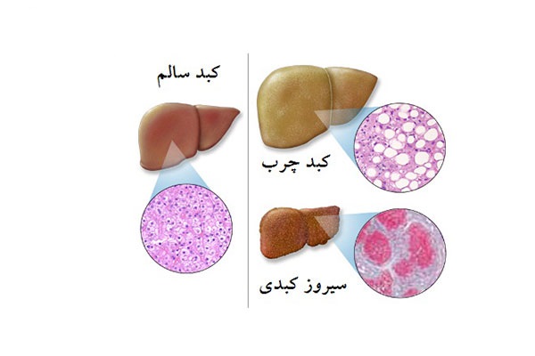  علت ایجاد «کبد چرب» چیست؟