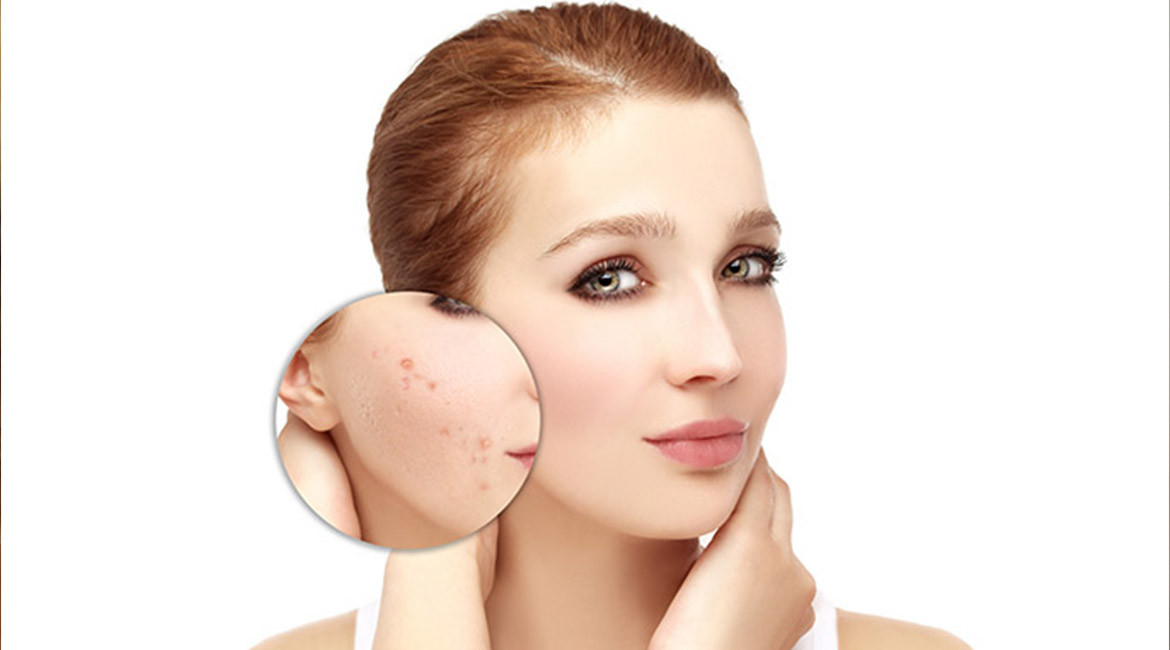 خطوط و جوش‌های صورت از وضعیت سلامتی‌تان می‌گویند