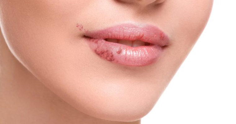 چطور جلوی عود تبخال را بگیریم؟