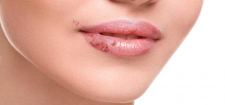 چطور جلوی عود تبخال را بگیریم؟