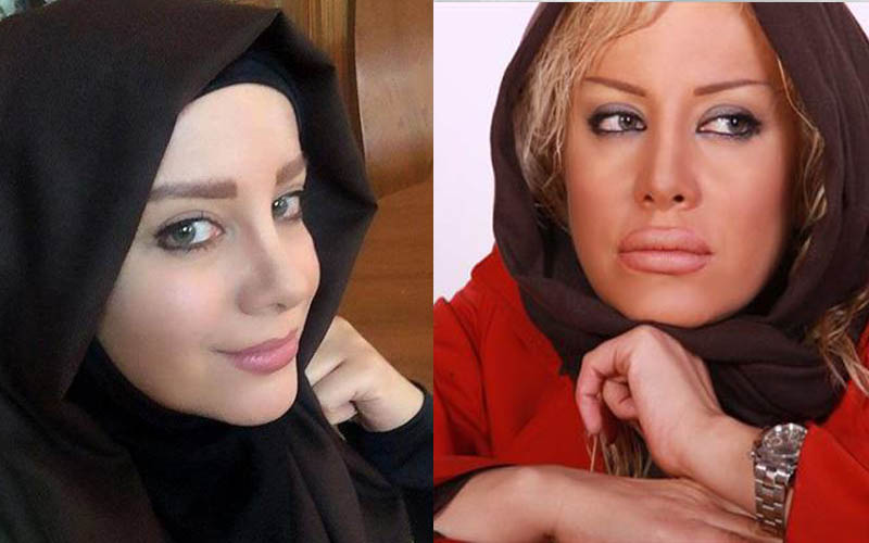 بازیگر زن از پروتز لبش می گوید/وقتی عمل زیبایی دردسرساز می‌شود