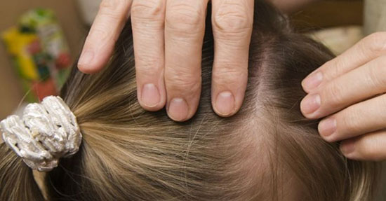  این علائم ثابت می‌کند شپش دارید