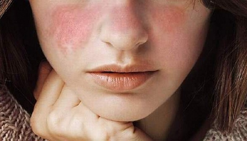 با چه سلاحی به جنگ  لوپوس برویم؟
