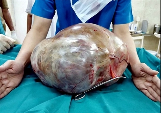 تومور ۱۱ کیلویی در شکم زن هندی! + عکس