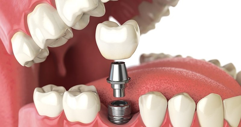 ایمپلنت دندان چقدر عمر می کند
