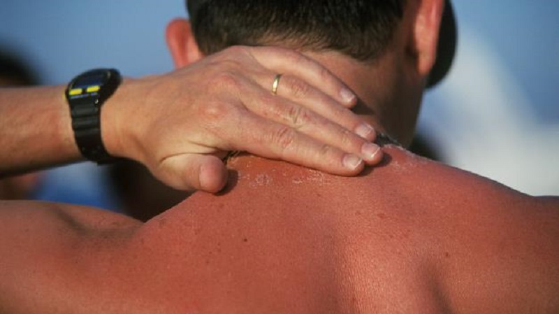 درمان آفتاب سوختگی با روش های طبیعی
