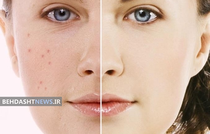 جای جوش‌ها را به کمک این دارو محو کنید 