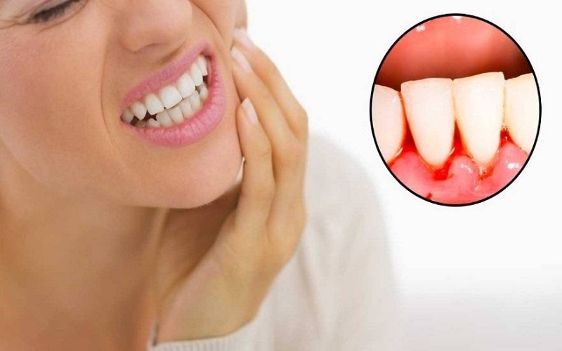  متورم شدن لثه نشانه این بیماری است