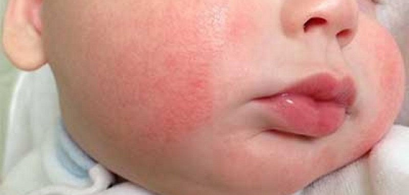 چگونه اگزما را درمان کنیم