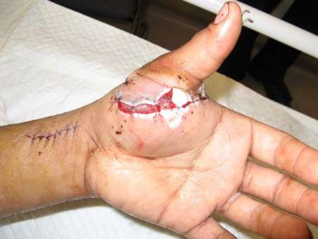 جراحی نادر پیوند انگشت دست در مشهد