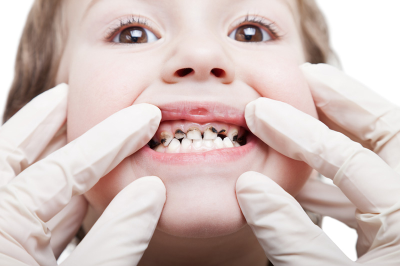 آمار پوسیدگی دندان در بین دانش آموزان رو به افزایش است 