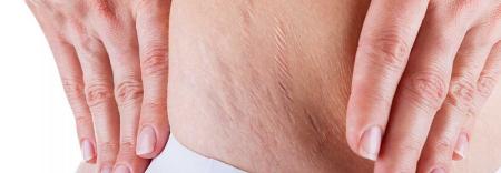 علل و درمان استرچ مارک یا ترک های پوستی