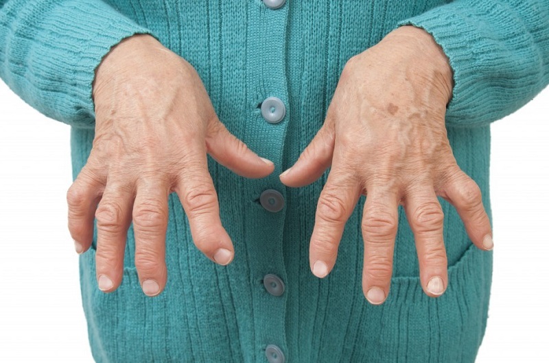 علل، علایم و علاج بیماری آرتریت روماتوئید