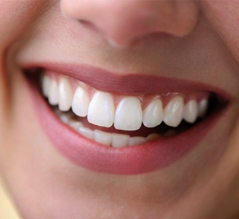  عوارض لمینیت دندان به جای ارتودنسی 