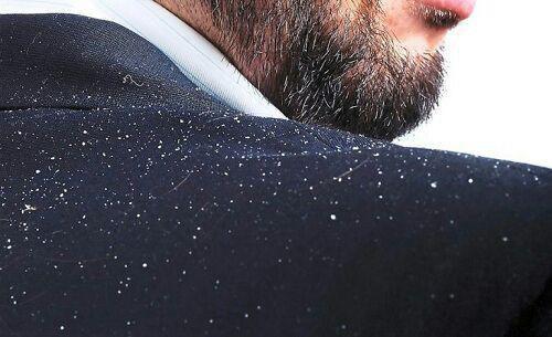  برای رهایی از شوره سر، سمت این مواد غذایی نروید