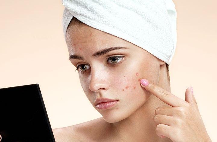 با این روش ها جوش های صورت را یک ماهه از بین ببرید