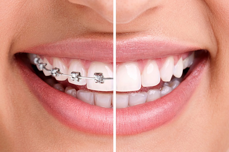 چه اتفاقی می افتد که دندان هایمان نامرتب می شوند؟ 