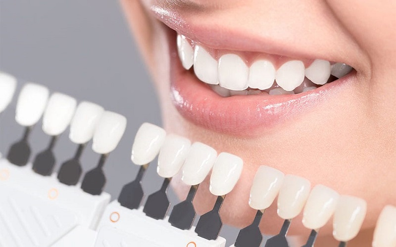 مناسب‌ترین شیوه تغییر فرم دندان‌ها به جای ارتودنسی
