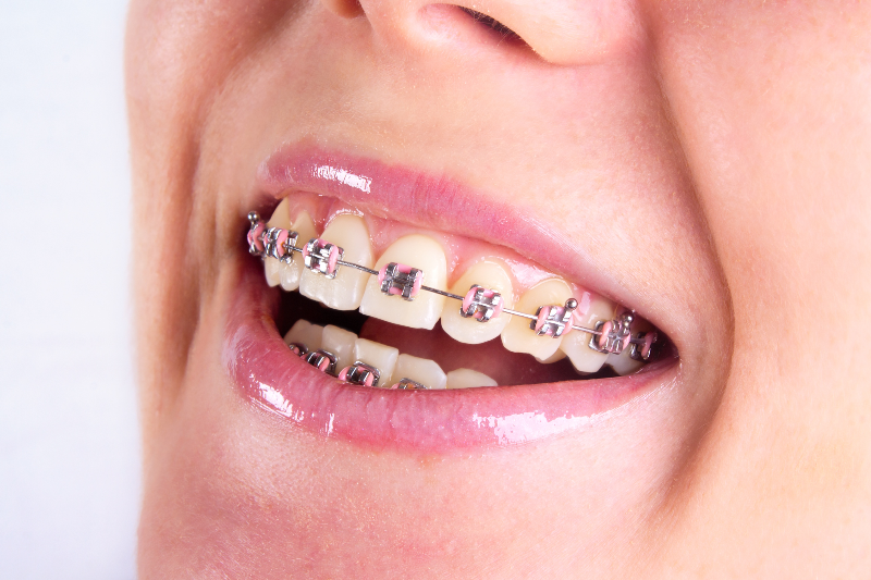 مناسب‌ترین شیوه تغییر فرم دندان‌ها به جای ارتودنسی