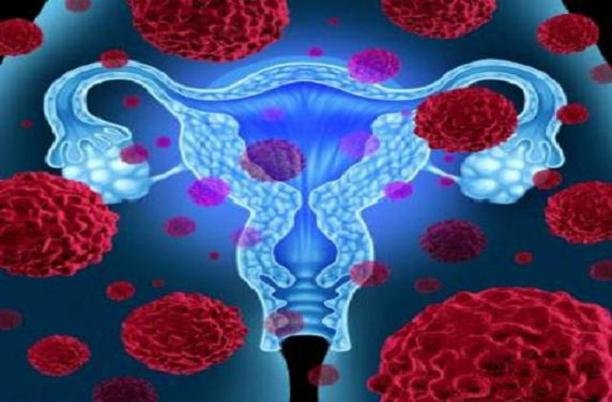 شیوع سندروم تخمدان در زنان و دختران
