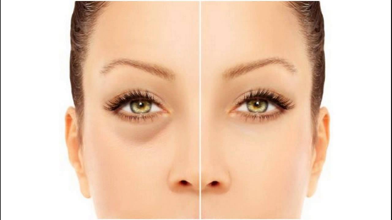 پف زیر چشم را چگونه از بین ببریم؟