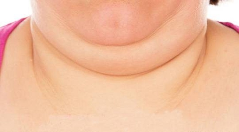 چربی اضافه گردن و اطراف چانه را فوری برطرف کنید