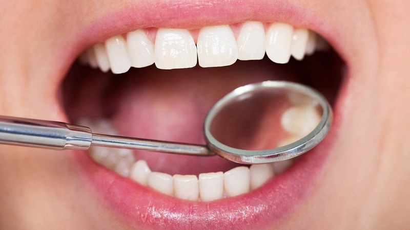 لکه های سفید روی دندان را با این روش ها از بین ببرید