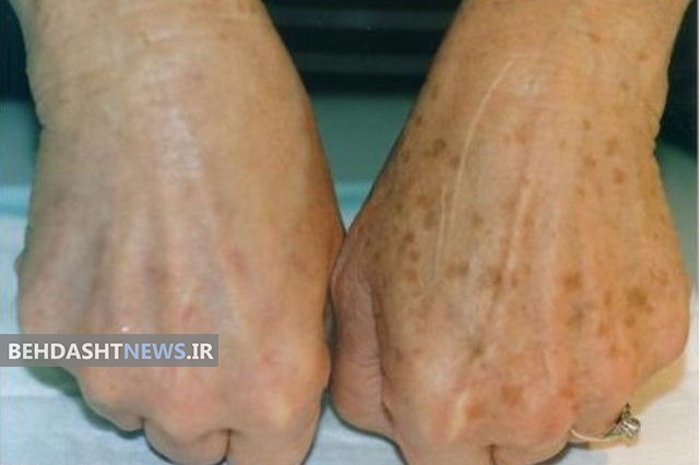  از بین بردن لکه های قهوه ای روی پوست با درمان خانگی