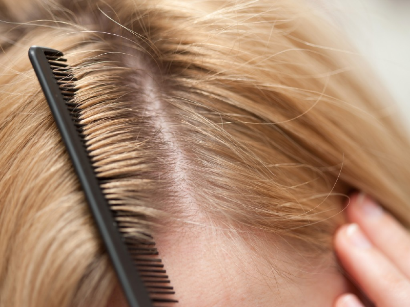 ۱۲ درمان مفید و کاربردی برای ریزش مو در زنان
