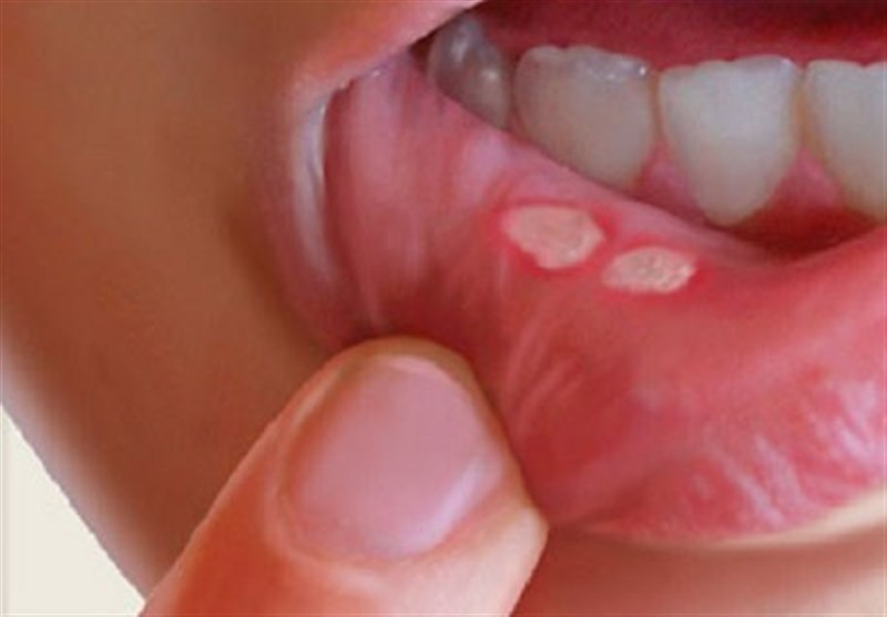 درمان سریع زخم دهان