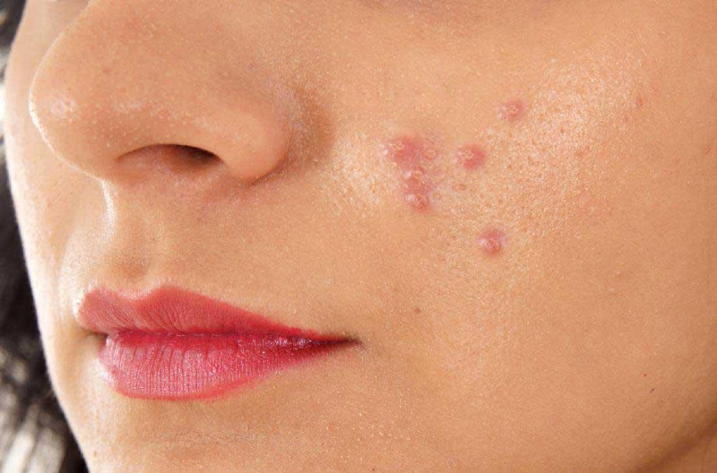    گوشی موبایل چطور باعث جوش صورت می‌شود؟