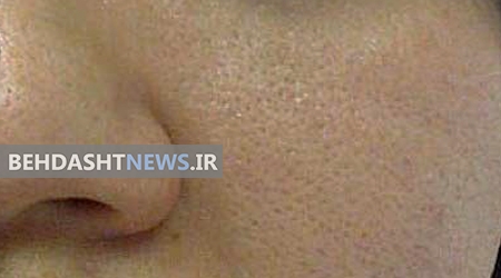 چگونه منافذ باز پوست را محو کنیم؟