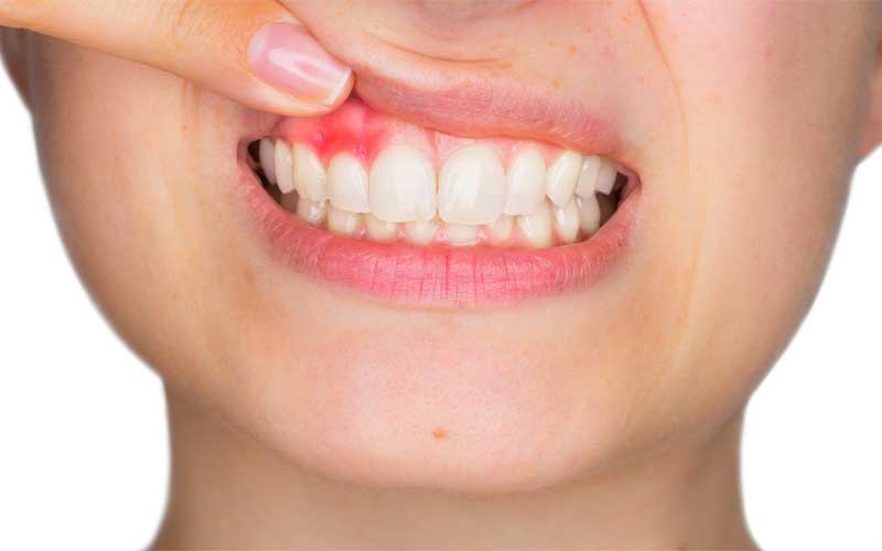 لثه ها به 6 دلیل دچار خونریزی می شوند