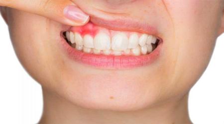 لثه ها به 6 دلیل دچار خونریزی می شوند