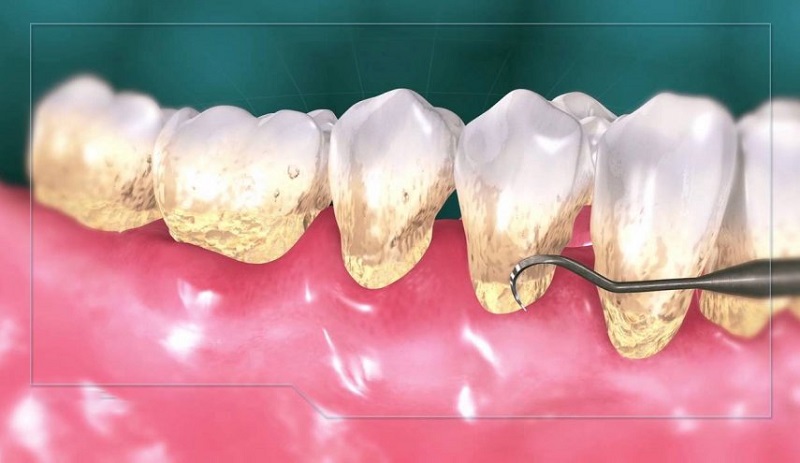 عوارض جرم گیری بر روی دندانها