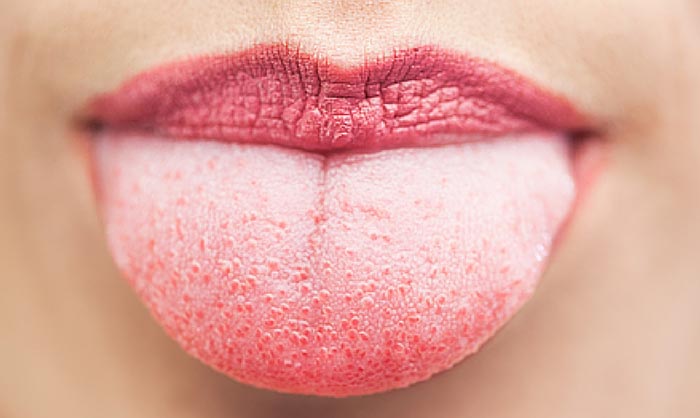  سفید شدن زبان نشانه چیست؟+ درمان سفیدی زبان به کمک طب خانگی و سنتی
